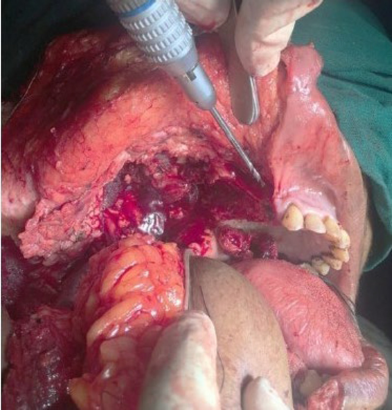 Modified Technique of Pectoralis Major Myocutaneous Flap Inset for Buccal Mucosa Reconstruction.