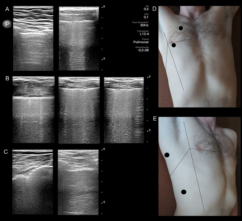 Time course of lung ultrasound findings in patients with COVID-19 pneumonia and cardiac dysfunction.