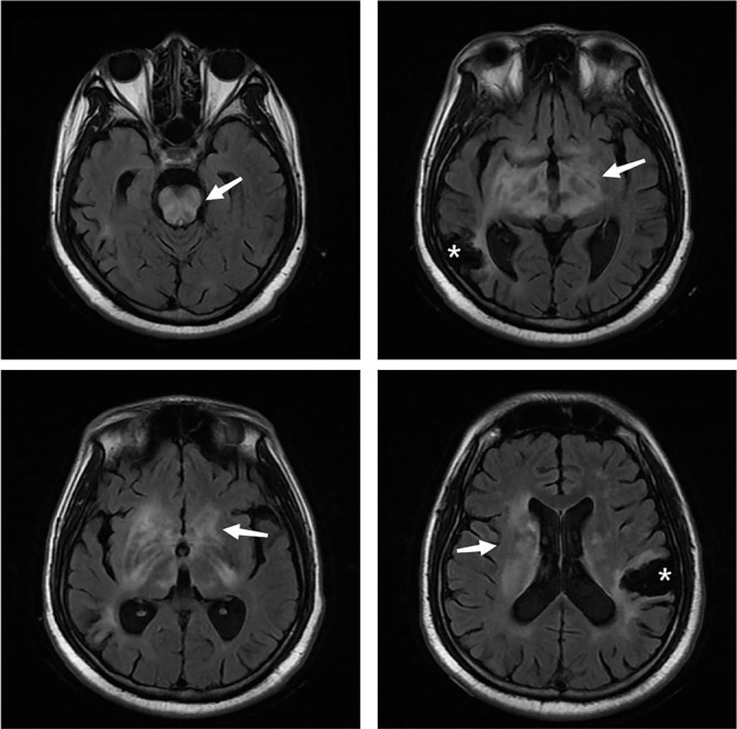 Recurrent Non-stroke Central Neurologic Manifestations in Primary Antiphospholipid Syndrome.