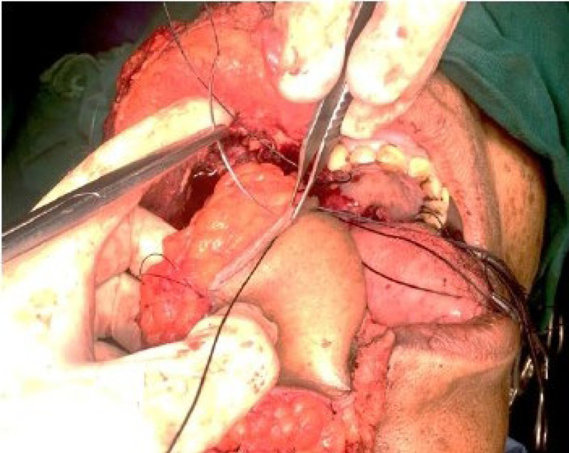 Modified Technique of Pectoralis Major Myocutaneous Flap Inset for Buccal Mucosa Reconstruction.