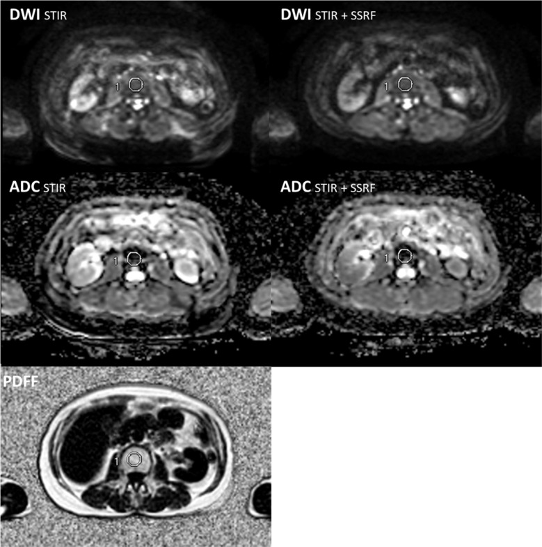 Assessing the ADC of Bone-marrow on Whole-body MR Images in Relation to the Fat-suppression Method and Fat Content.