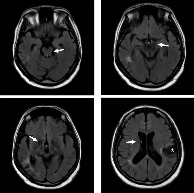 Recurrent Non-stroke Central Neurologic Manifestations in Primary Antiphospholipid Syndrome.