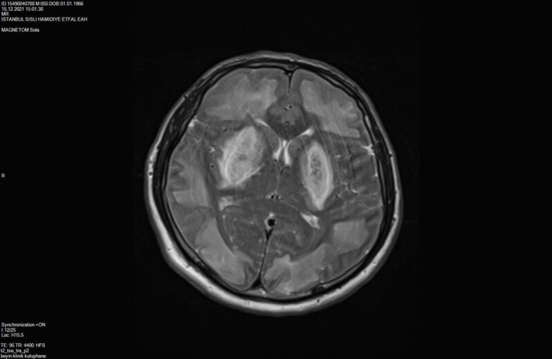 CT and MR Imaging Findings in Methanol Intoxication Manifesting with BI Lateral Severe Basal Ganglia and Cerebral Involvement.