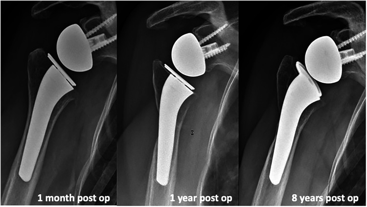 Specific Design of a Press Fit Humeral Stem Provides low Stress Shielding in Reverse Shoulder Arthroplasty at minimum 5 Years FU.