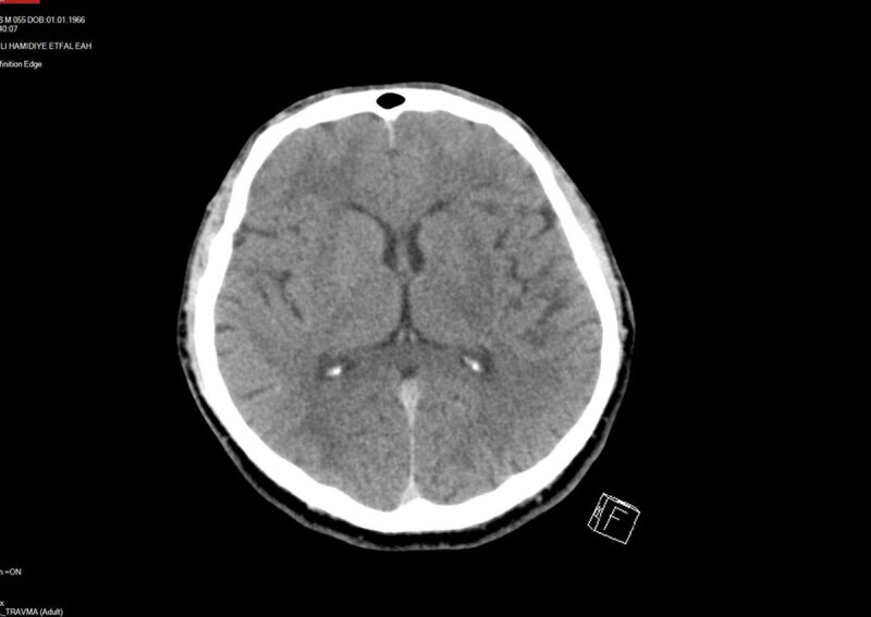 CT and MR Imaging Findings in Methanol Intoxication Manifesting with BI Lateral Severe Basal Ganglia and Cerebral Involvement.