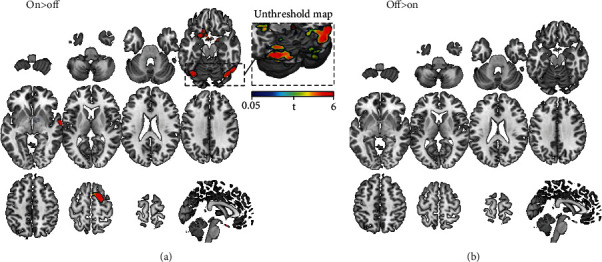 Local and Distributed fMRI Changes Induced by 40 Hz Gamma tACS of the Bilateral Dorsolateral Prefrontal Cortex: A Pilot Study.