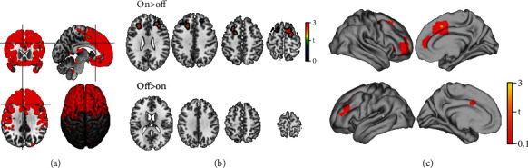 Local and Distributed fMRI Changes Induced by 40 Hz Gamma tACS of the Bilateral Dorsolateral Prefrontal Cortex: A Pilot Study.