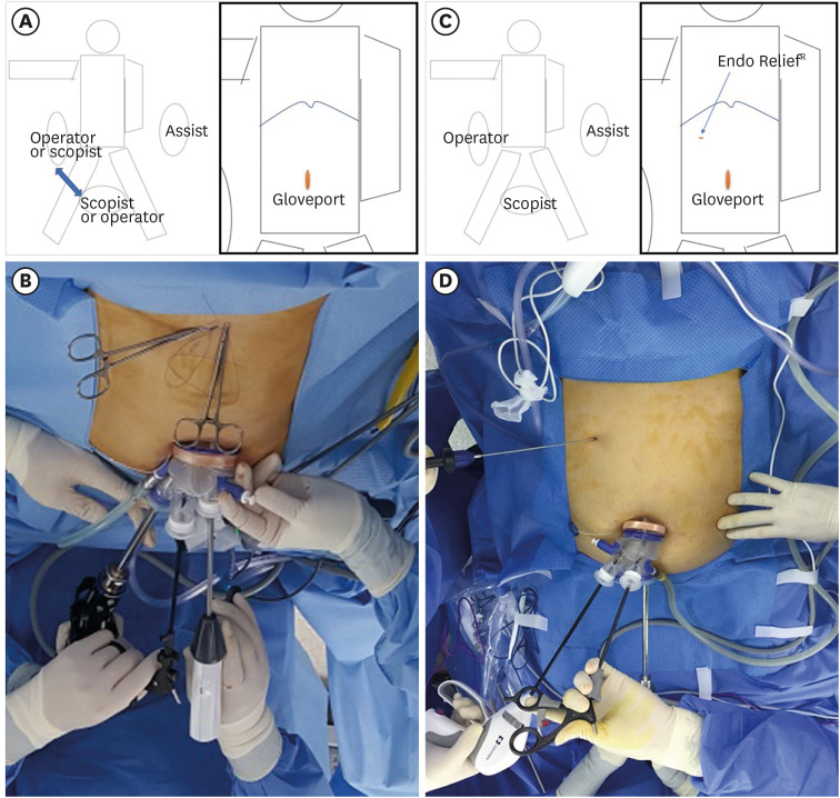 Convenience of Adding a Needle Grasper in Single-Incision Laparoscopic Distal Gastrectomy With Billroth I Anastomosis for Clinical Early Gastric Cancer.