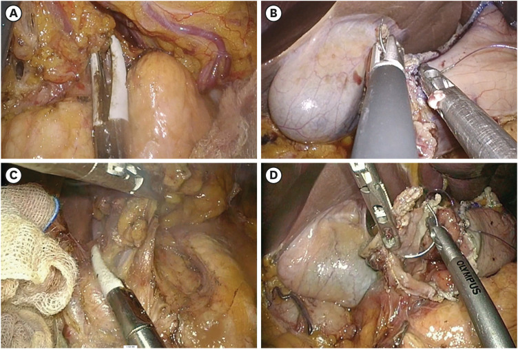 Convenience of Adding a Needle Grasper in Single-Incision Laparoscopic Distal Gastrectomy With Billroth I Anastomosis for Clinical Early Gastric Cancer.