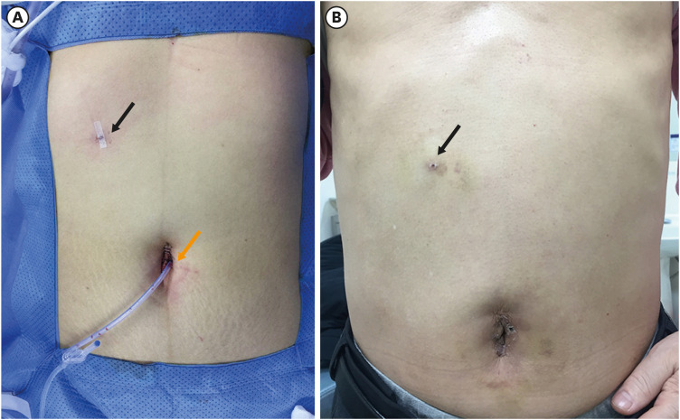 Convenience of Adding a Needle Grasper in Single-Incision Laparoscopic Distal Gastrectomy With Billroth I Anastomosis for Clinical Early Gastric Cancer.