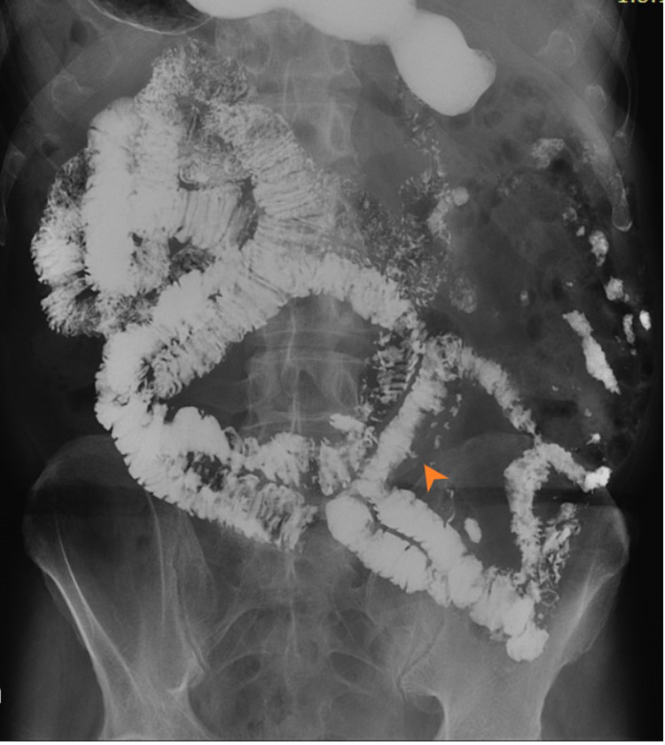 Enterolith Causing Small Bowel Obstruction: Report of a Case and Review of Literature.