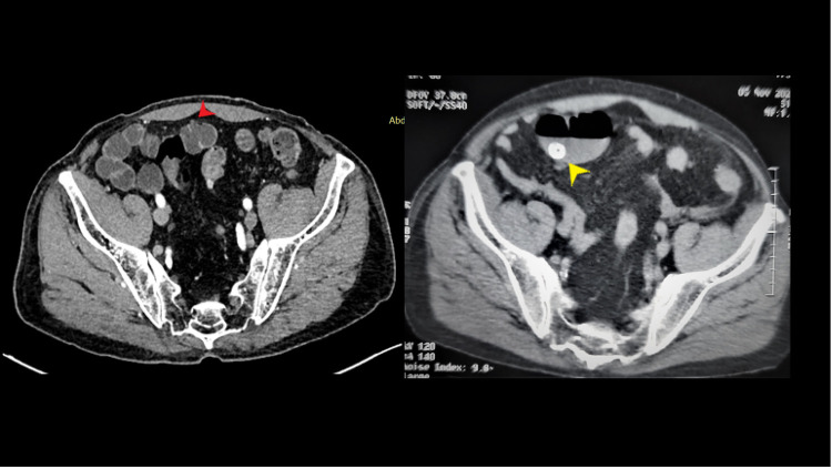 Enterolith Causing Small Bowel Obstruction: Report of a Case and Review of Literature.