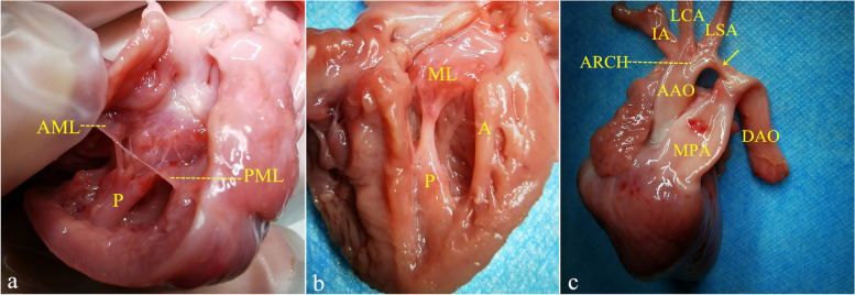 Can prenatal diagnosis of parachute mitral valve be achieved? A case report of fetal parachute mitral valve.