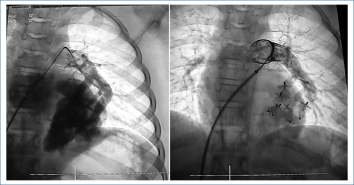 Percutaneous occlusion of five pulmonary arteriovenous fistulas in the same pulmonary lobe.