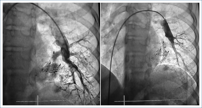 Percutaneous occlusion of five pulmonary arteriovenous fistulas in the same pulmonary lobe.