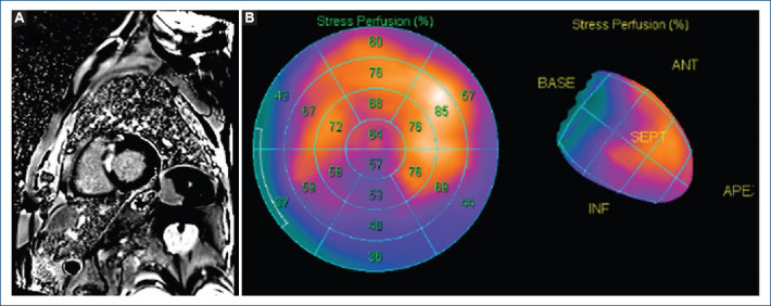 A rare coronary anomaly as a possible cause of ventricular tachycardia