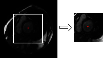 Left Ventricle Segmentation in Cardiac MR Images via an Improved ResUnet.