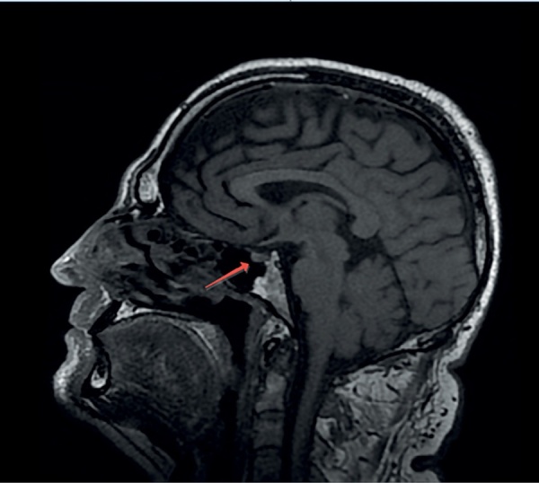 [Diagnosis and tactics of managing a patient with central diabetes insipidus on the example of a clinical case].