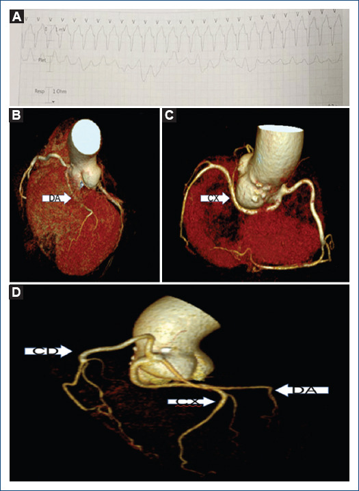 A rare coronary anomaly as a possible cause of ventricular tachycardia