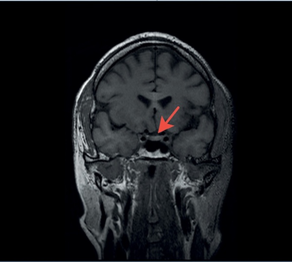 [Diagnosis and tactics of managing a patient with central diabetes insipidus on the example of a clinical case].