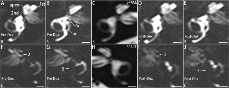 Dexamethasone does not affect endolymphatic hydrops (EH) in patients with Meniere's disease within 24 h, and intratympanic administration of gadolinium plus dexamethasone simplifies high-quality imaging of EH using a novel protocol of 7 min