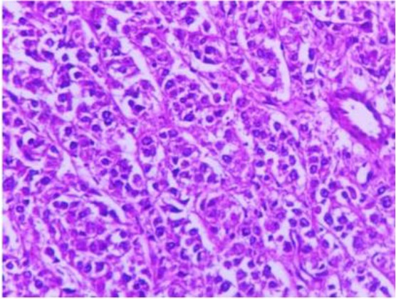 PEComa-A Rare Uterine Neoplasm: A Case Report.