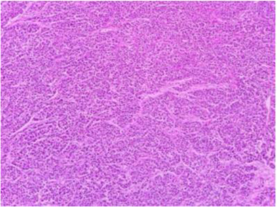 PEComa-A Rare Uterine Neoplasm: A Case Report.