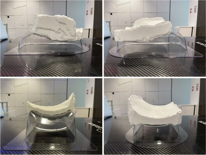 3D printed integrated bolus/headrest for radiation therapy for malignancies involving the posterior scalp and neck.