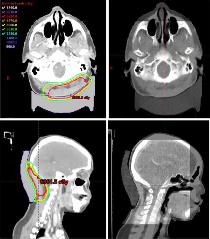 3D printed integrated bolus/headrest for radiation therapy for malignancies involving the posterior scalp and neck.