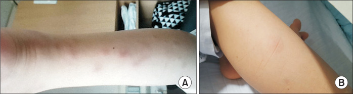 Pediatric Sarcoidosis Misdiagnosed as Hepatosplenic Abscesses: A Case Report and Review.