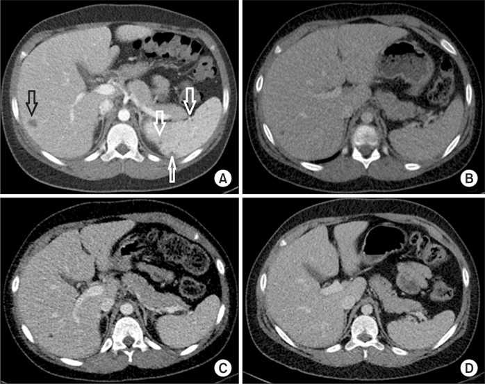 Pediatric Sarcoidosis Misdiagnosed as Hepatosplenic Abscesses: A Case Report and Review.