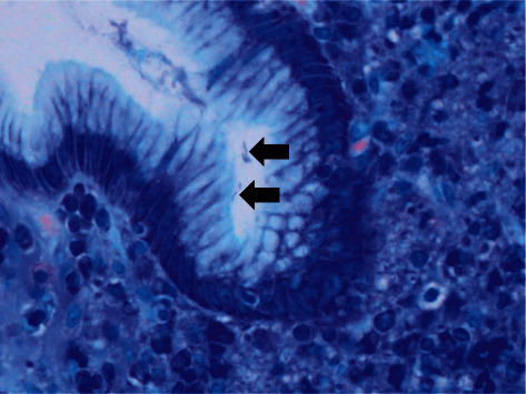 <i>Helicobacter suis</i>-Associated Gastritis Mimicking Conventional <i>H. pylori</i>-Associated Atrophic Gastritis.