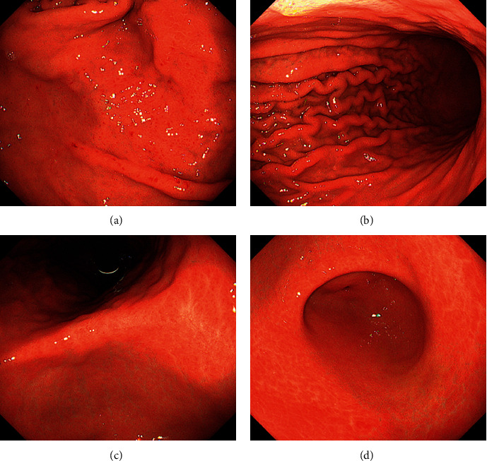 <i>Helicobacter suis</i>-Associated Gastritis Mimicking Conventional <i>H. pylori</i>-Associated Atrophic Gastritis.