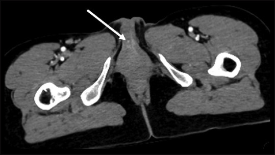 Vaginal Injury by a Cow's Horn.