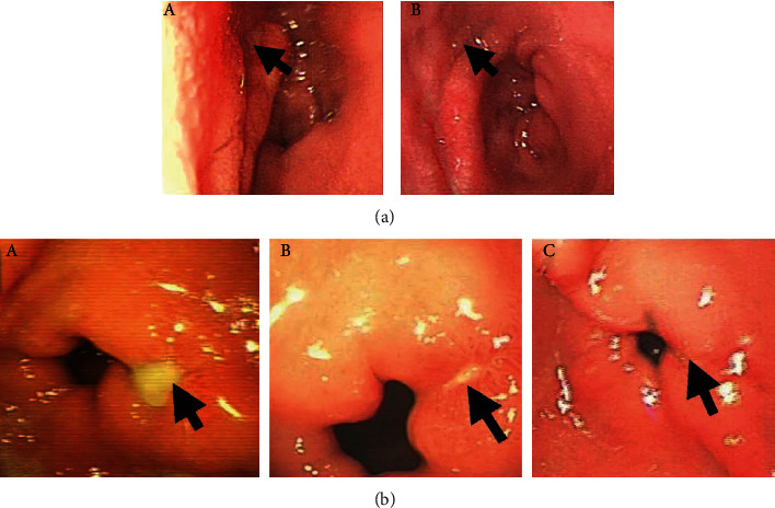 Effects of Autologous Platelet-Rich Plasma on Healing of Peptic Ulcers: A Randomized Controlled Trial.