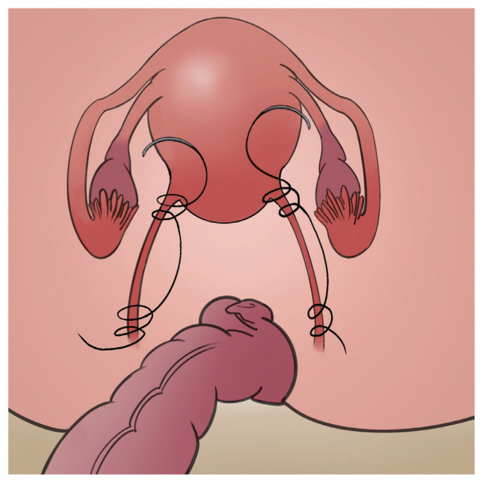 How and on whom to perform uterine-preserving surgery for uterine prolapse.