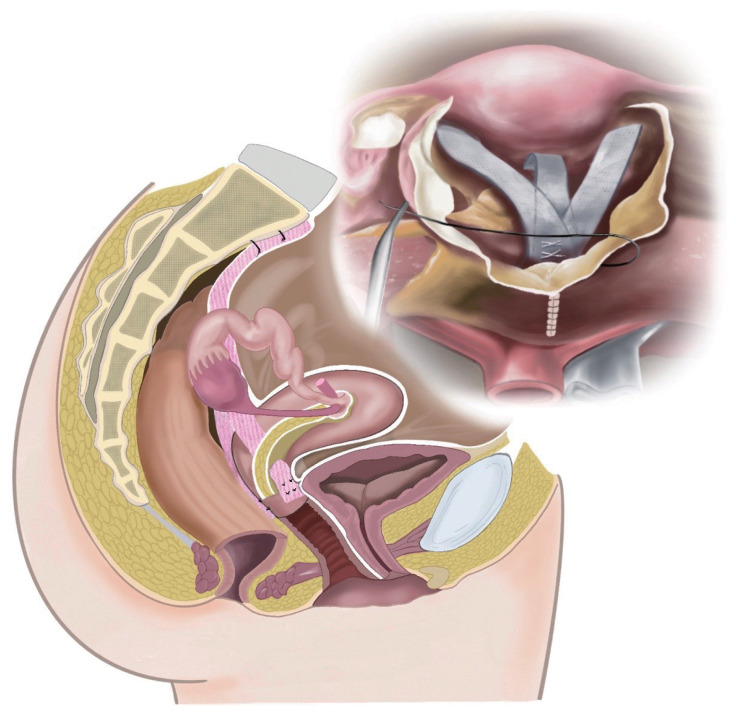 How and on whom to perform uterine-preserving surgery for uterine prolapse.