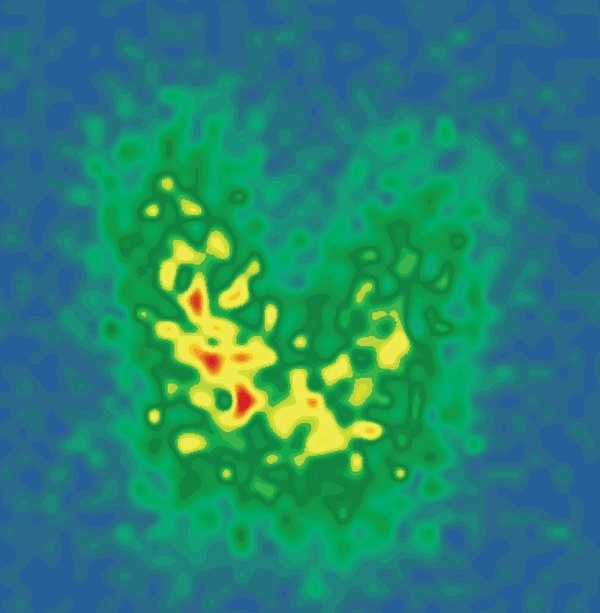 [Thyrotoxicosis in a patient with Turner syndrome: radioactive iodine therapy].