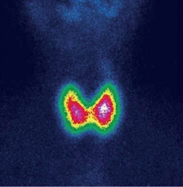 [Thyrotoxicosis in a patient with Turner syndrome: radioactive iodine therapy].