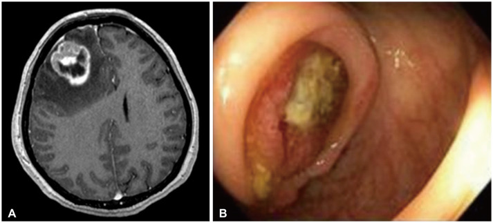 Cerebral Metastases in Appendiceal Cancer: Comprehensive Review and Report of Rare Medullary Carcinoma Histology.