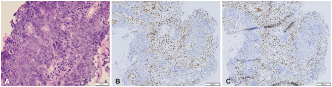 Cerebral Metastases in Appendiceal Cancer: Comprehensive Review and Report of Rare Medullary Carcinoma Histology.