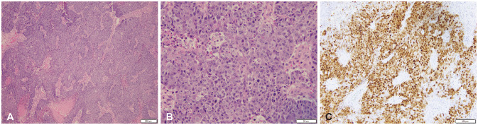 Cerebral Metastases in Appendiceal Cancer: Comprehensive Review and Report of Rare Medullary Carcinoma Histology.