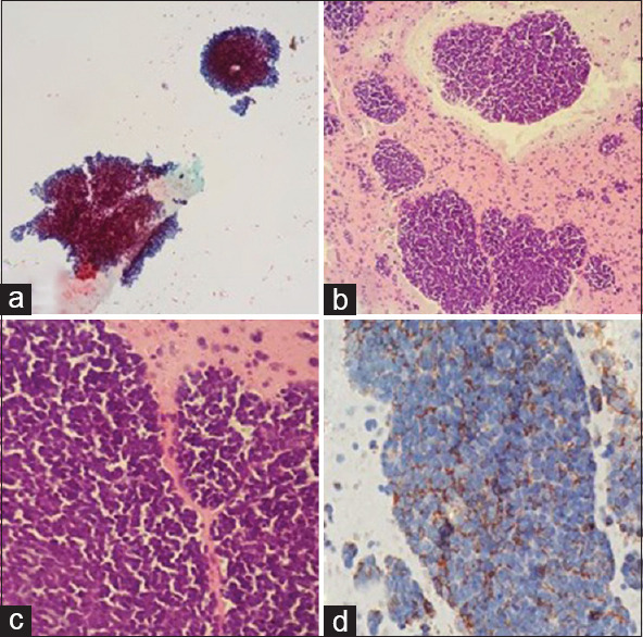 CSF Involvement by Nonhematolymphoid Malignancies: A Descriptive Study with Emphasis on Cytomorphological Clues.