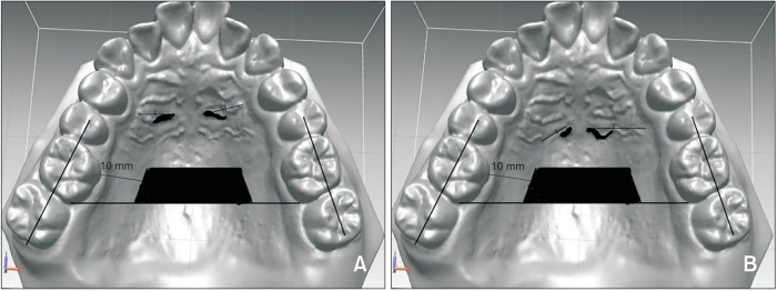 Validation of three-dimensional digital model superimpositions based on palatal structures in patients with maximum anterior tooth retraction following premolar extraction.