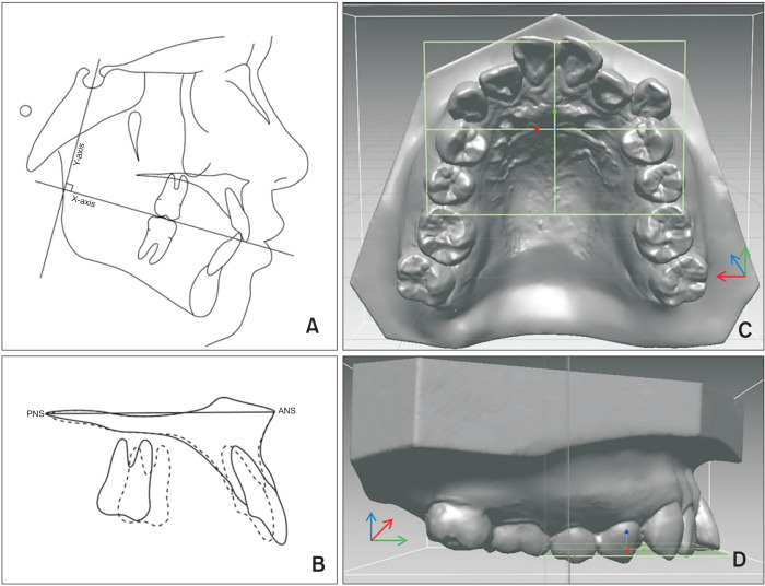 Validation of three-dimensional digital model superimpositions based on palatal structures in patients with maximum anterior tooth retraction following premolar extraction.