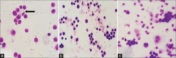 CSF Involvement by Nonhematolymphoid Malignancies: A Descriptive Study with Emphasis on Cytomorphological Clues.