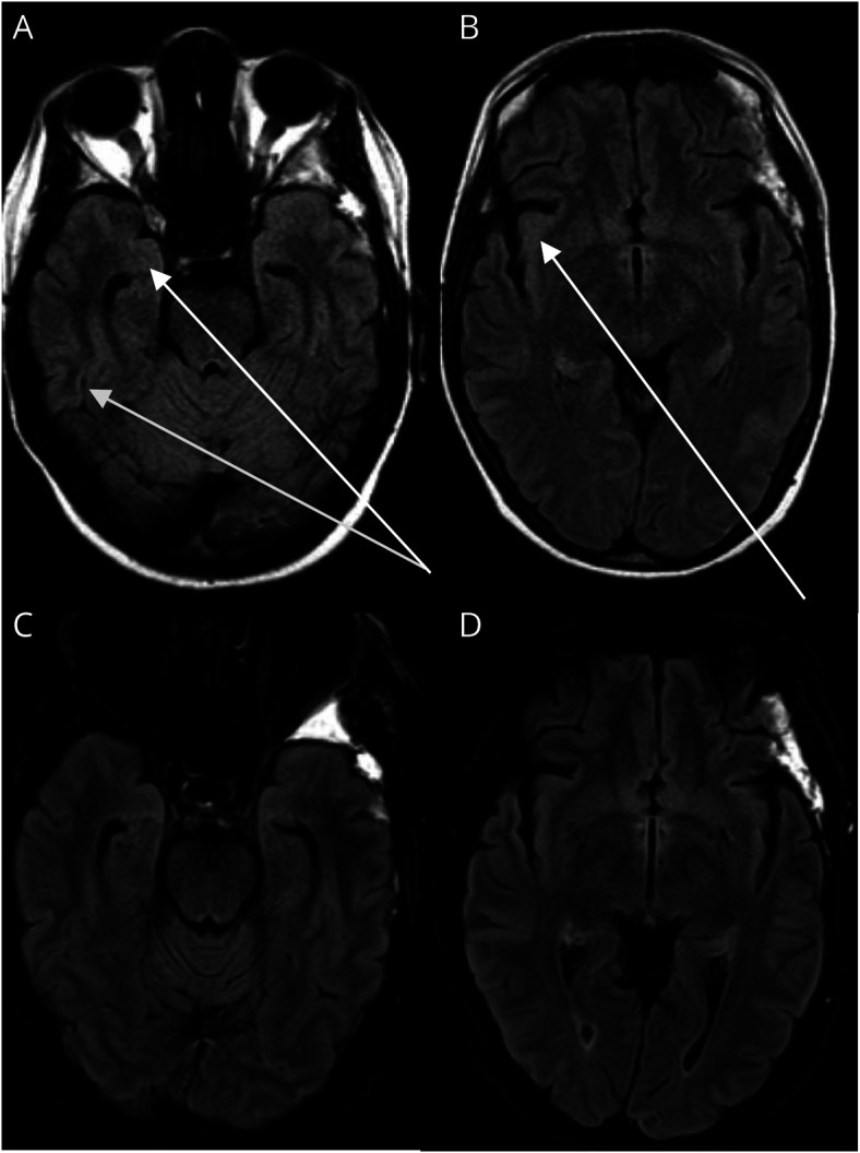 AMPA Receptor Encephalitis in a Patient With Metastatic Breast Cancer Receiving Palbociclib: A Case Report.