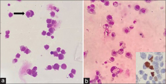 CSF Involvement by Nonhematolymphoid Malignancies: A Descriptive Study with Emphasis on Cytomorphological Clues.