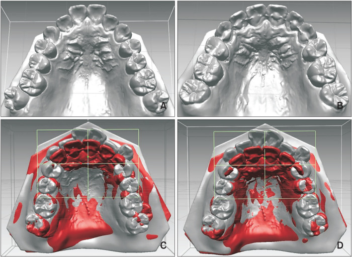 Validation of three-dimensional digital model superimpositions based on palatal structures in patients with maximum anterior tooth retraction following premolar extraction.