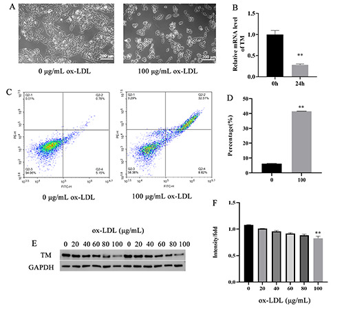 MiR-550a-3p restores damaged vascular smooth muscle cells by inhibiting thrombomodulin in an <em>in vitro</em> atherosclerosis model.